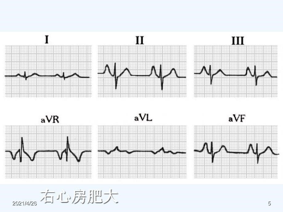 异常心电图ppt_第5页