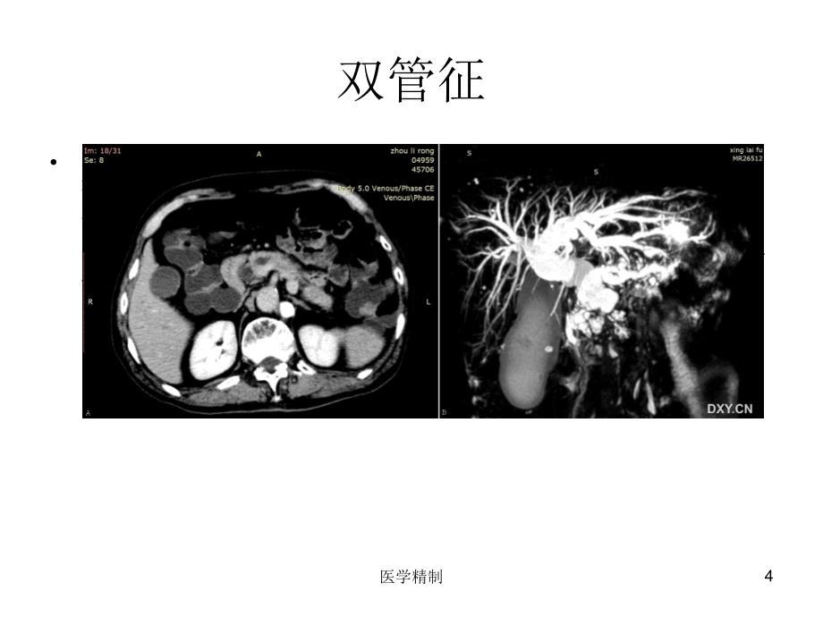 消化系统影像学征象归纳（内容详细）_第4页