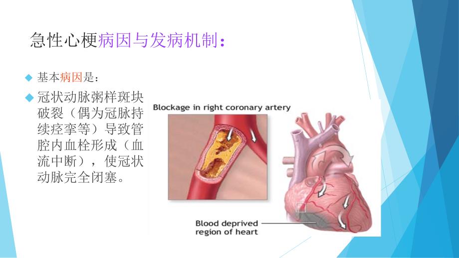 急性心梗溶栓的护理_第3页