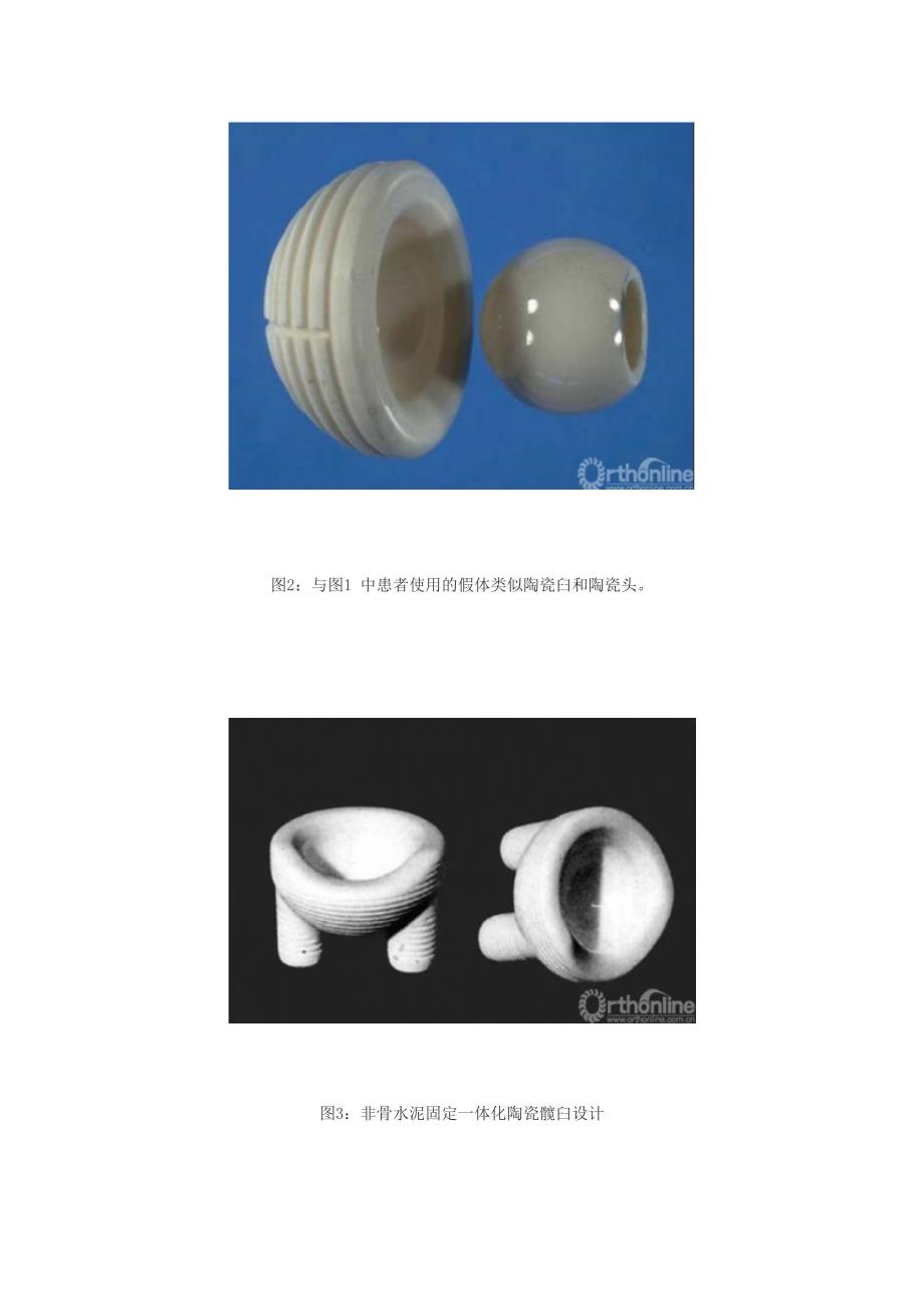 陶瓷髋关节置换术简史.doc_第3页