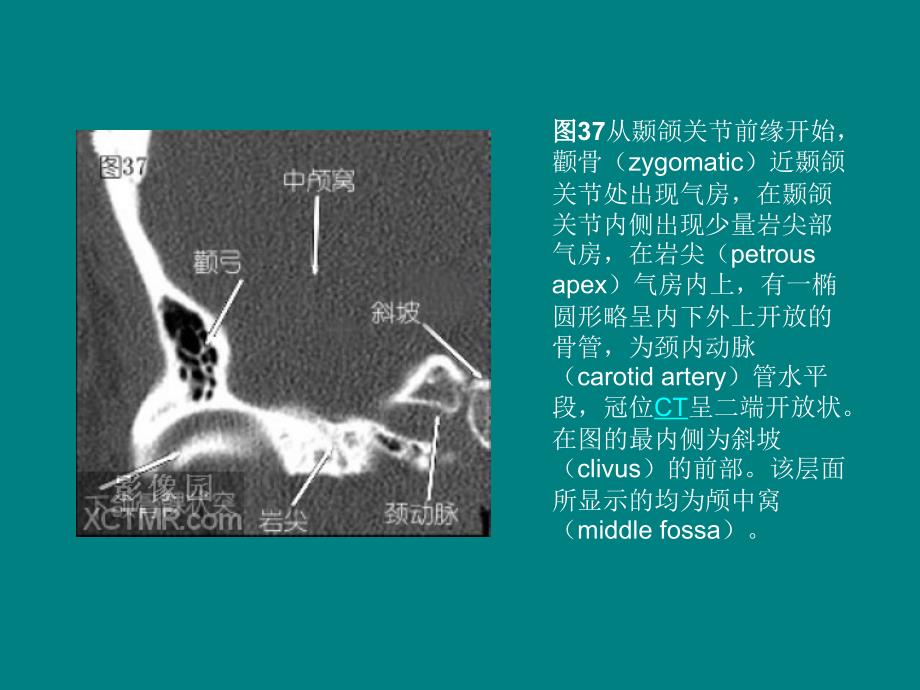 颞骨冠状位HRCT解剖迟放鲁_第4页