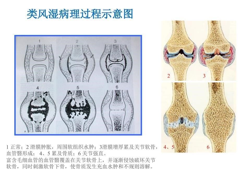 类风湿性炎的影像学诊断ppt课件_第5页