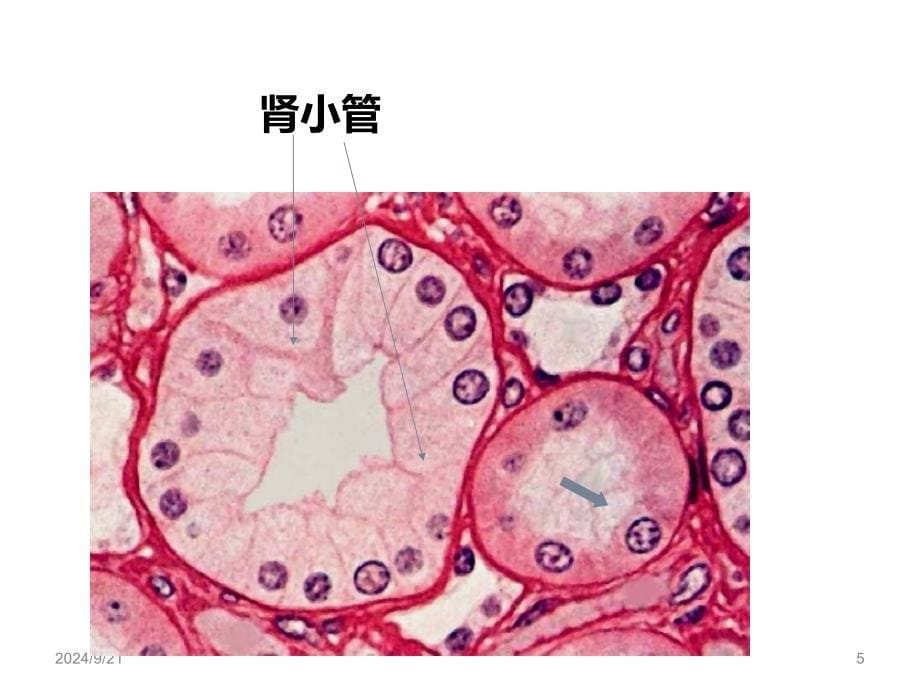 急性肾功能衰竭课件_第5页