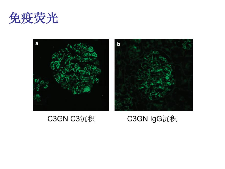 最新c3肾小球肾病 ppt课件PPT文档_第4页