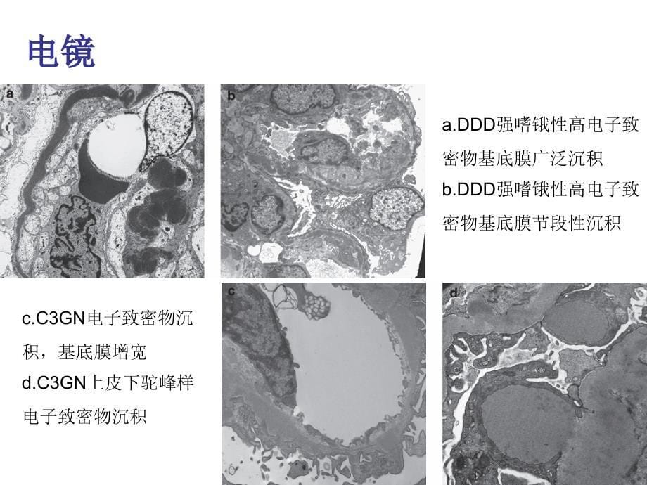 最新c3肾小球肾病 ppt课件PPT文档_第5页