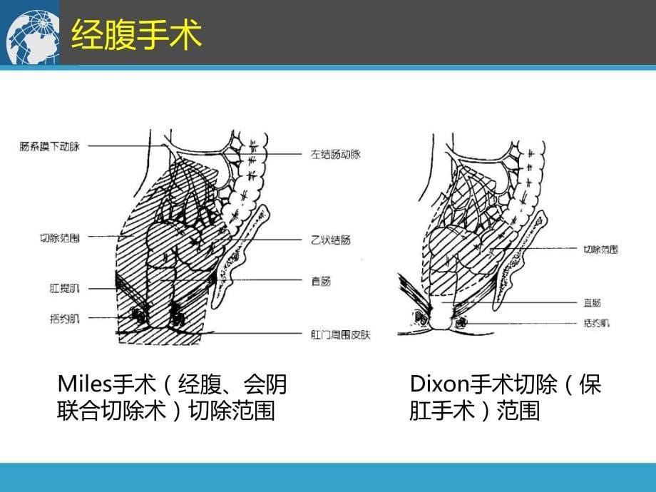 直肠癌治疗原则靶区勾画shen_第5页