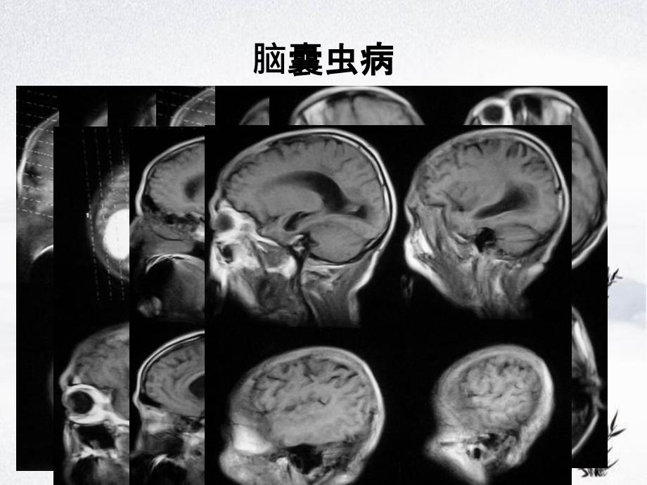 CNS疾病MRI诊断影像集萃三_第4页