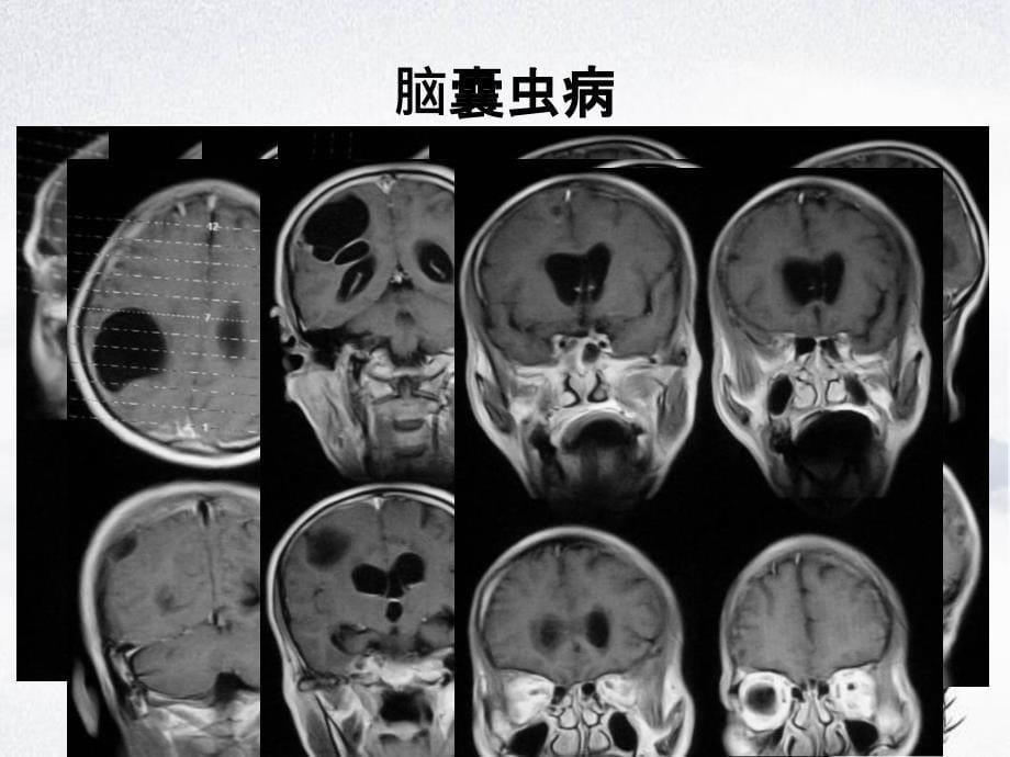 CNS疾病MRI诊断影像集萃三_第5页