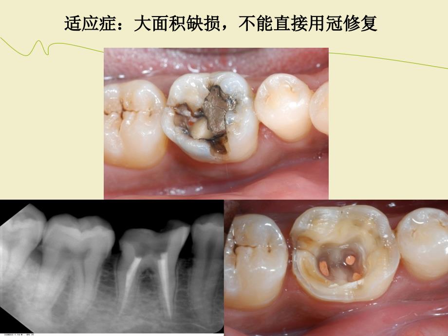 桩核冠修复浅析_第4页