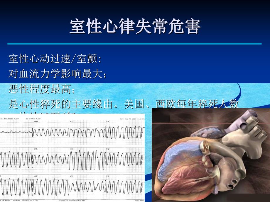 特发性室性心律失常消融治疗进展ppt课件_第2页