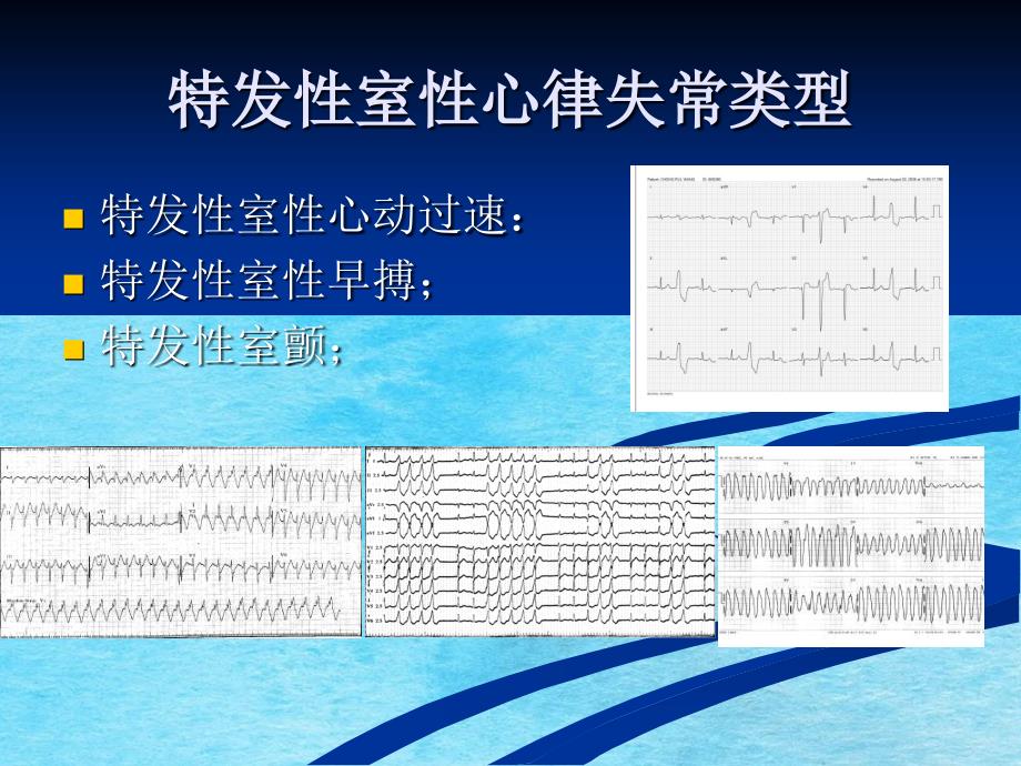 特发性室性心律失常消融治疗进展ppt课件_第4页