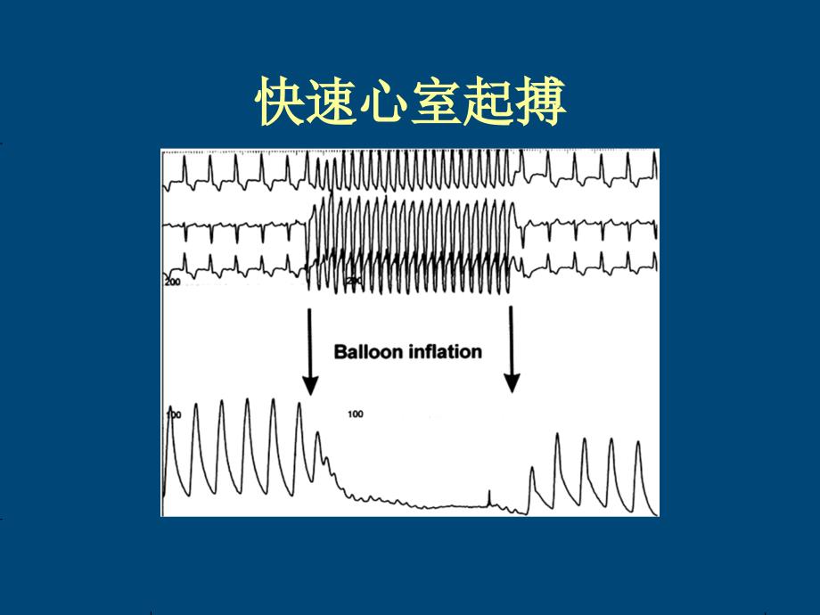 更多经皮瓣膜介入治疗循环支持课件_第4页