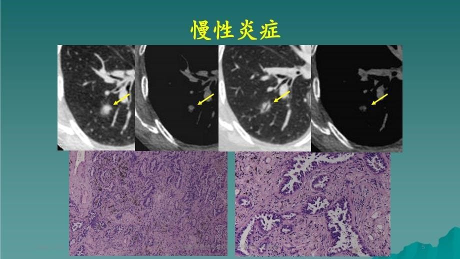 肺磨玻璃结节的CT诊断与随访_第5页