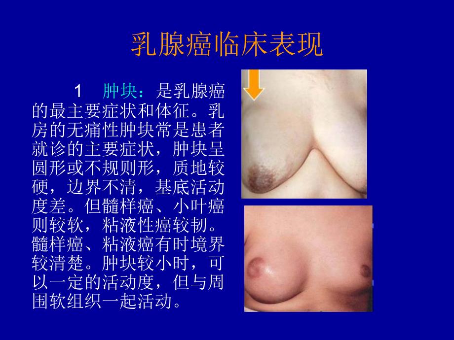 乳腺癌的X线诊断PPT课件_第4页