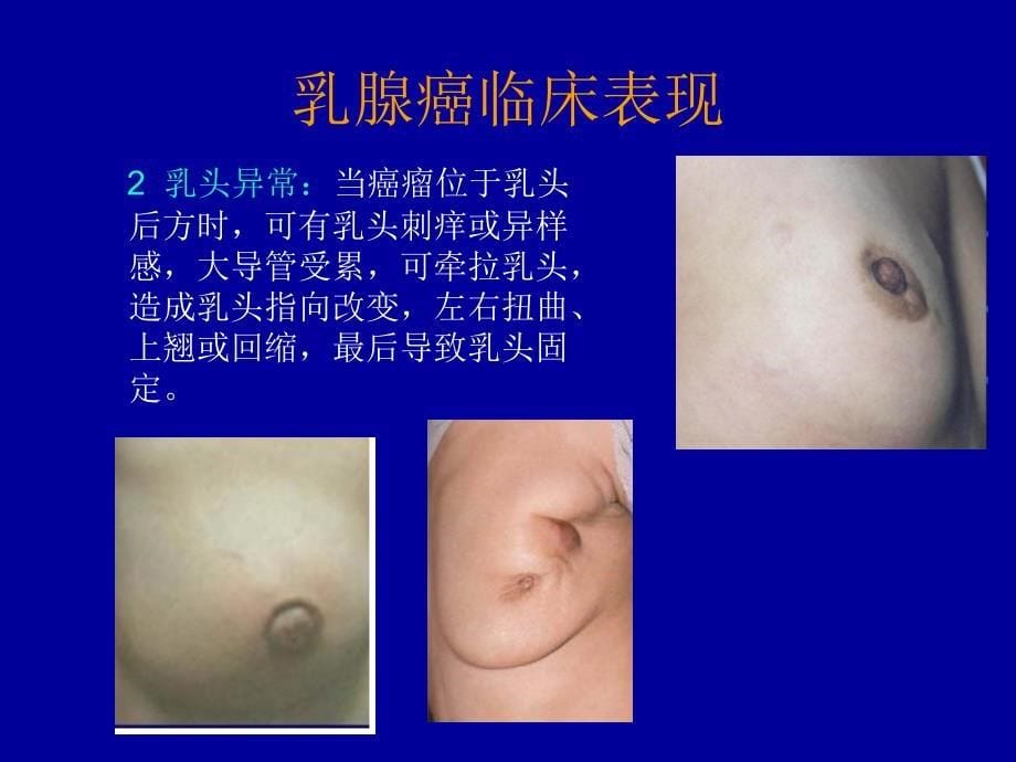 乳腺癌的X线诊断PPT课件_第5页