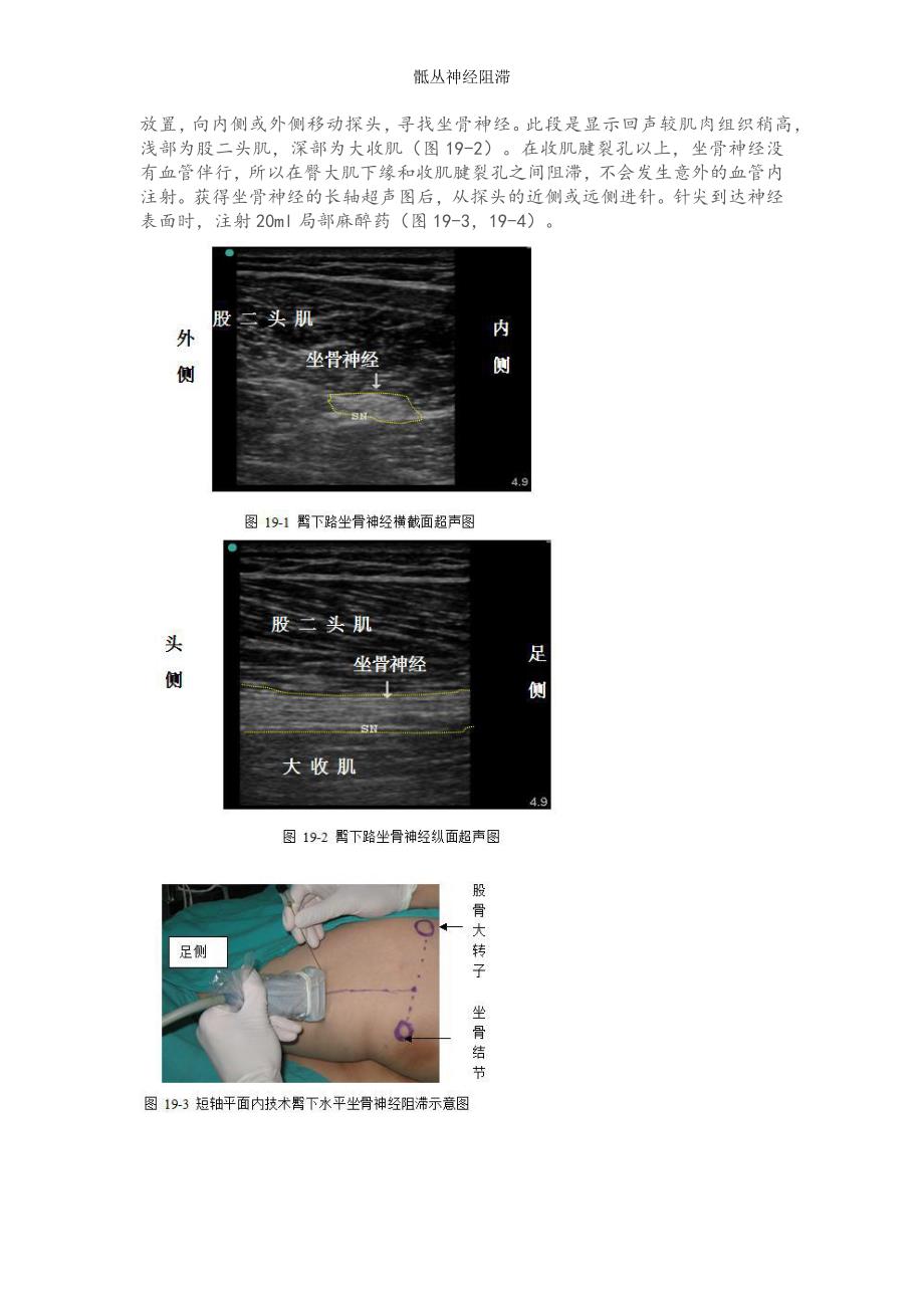 骶丛神经阻滞.doc_第4页