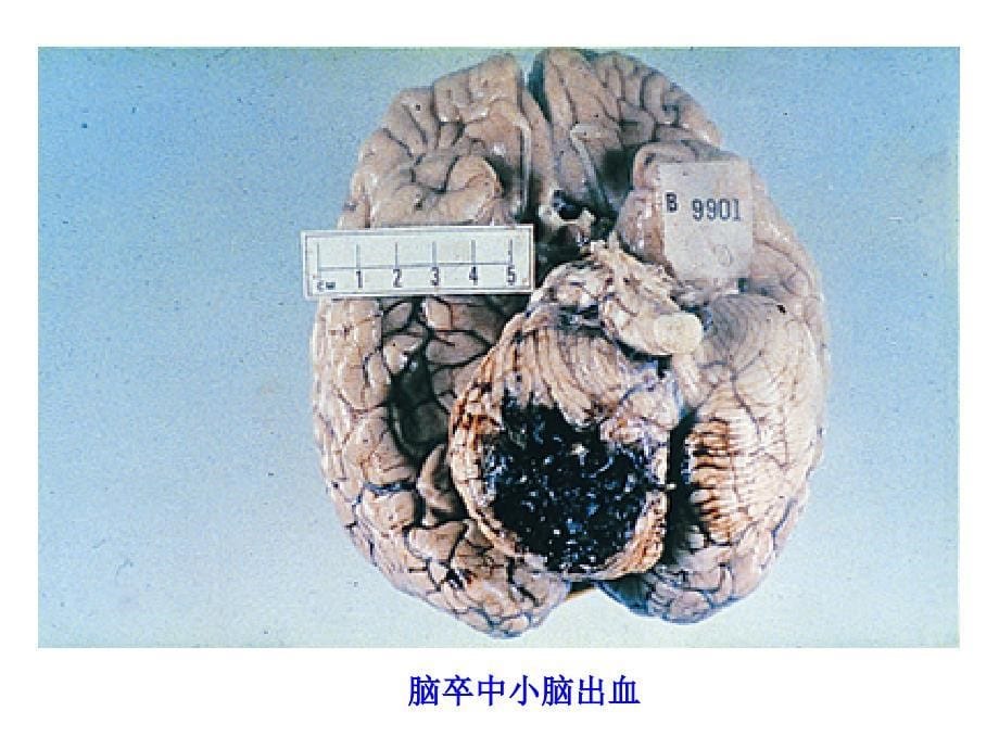 老年高血压患者的合理用药课件_第5页