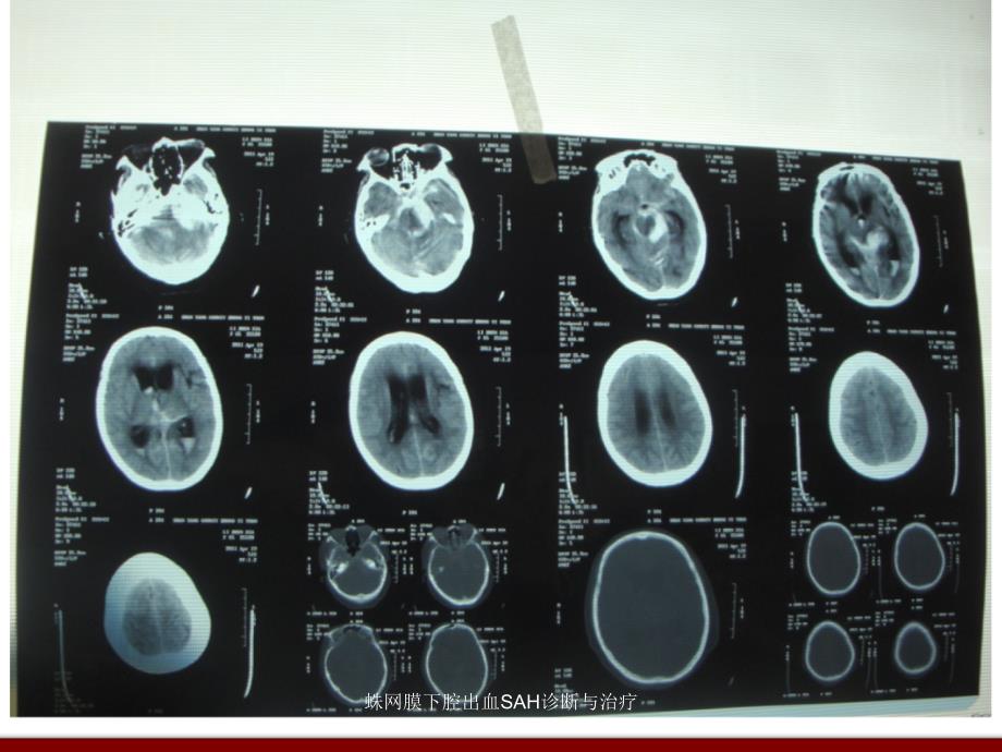 蛛网膜下腔出血SAH诊断与治疗课件_第2页