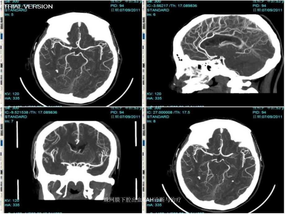 蛛网膜下腔出血SAH诊断与治疗课件_第3页