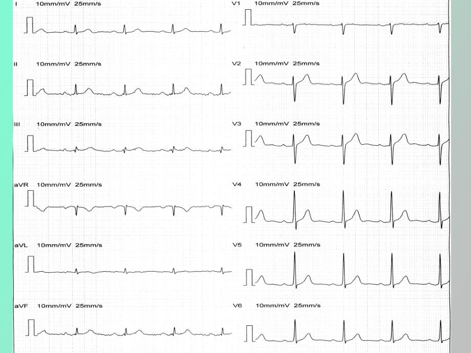 正常及异常心电_第3页