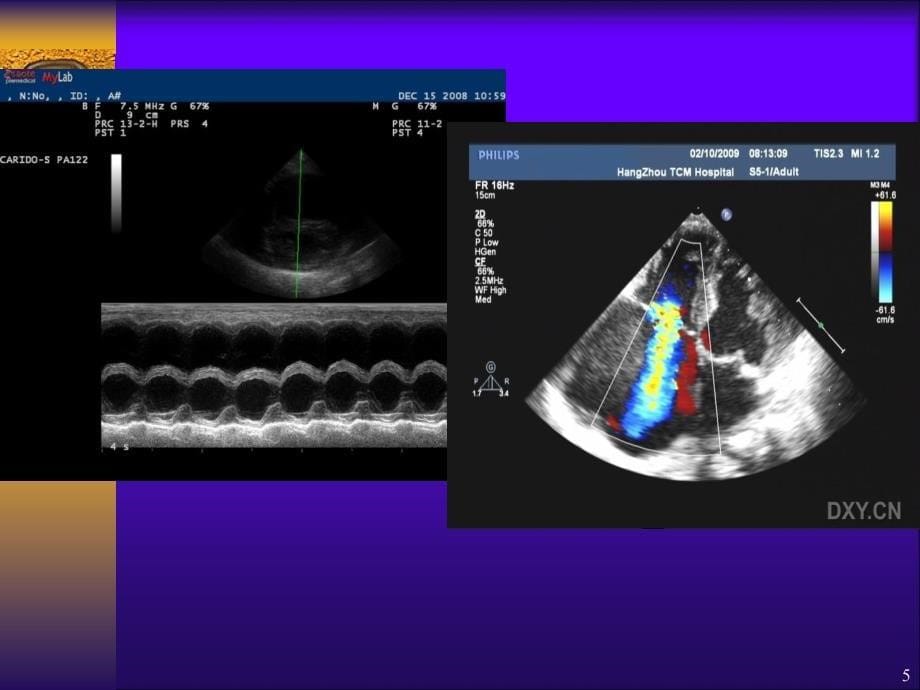心脏彩超的临床应用ppt课件_第5页
