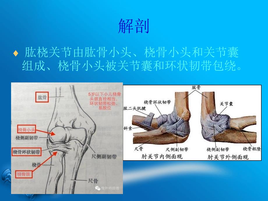 桡骨小头半脱位课件_第3页