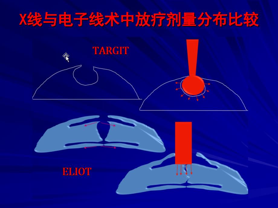 汪延明教授 术中放疗课件.3.10_第4页