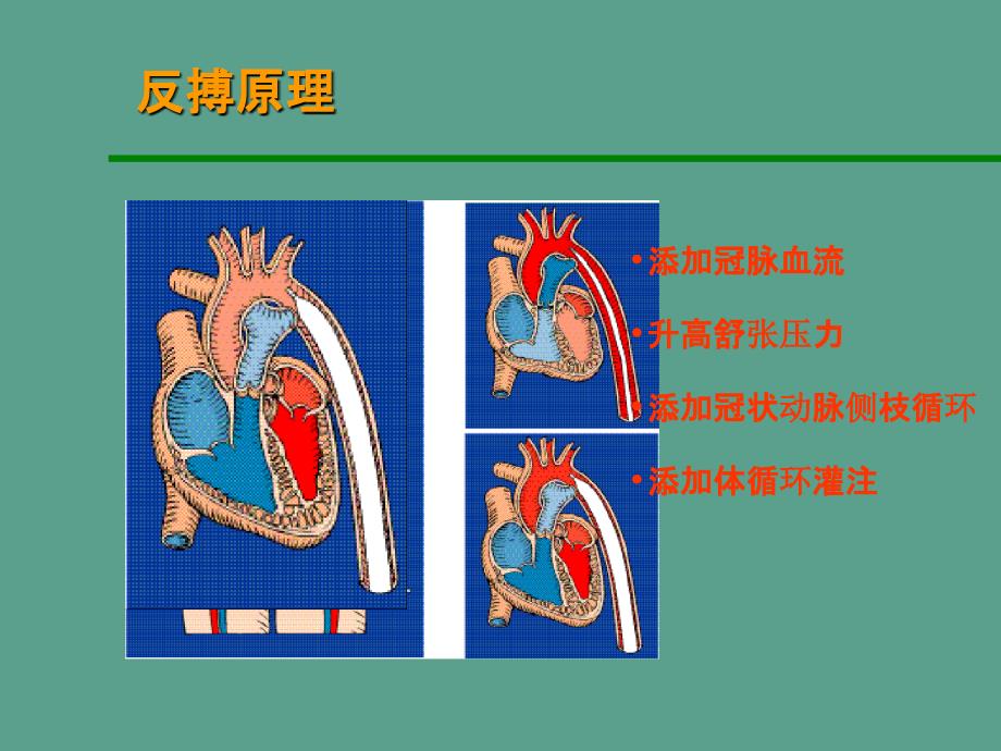 主动脉内球囊反搏泵ppt课件_第3页