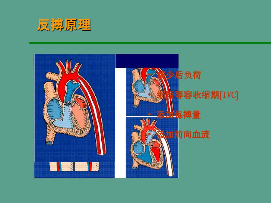 主动脉内球囊反搏泵ppt课件_第4页