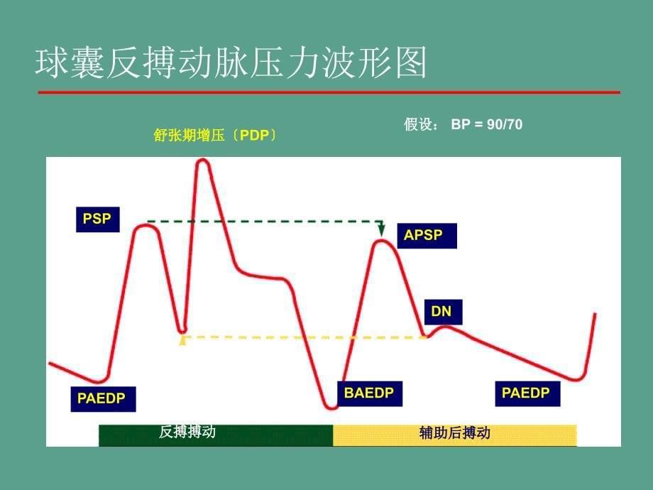 主动脉内球囊反搏泵ppt课件_第5页