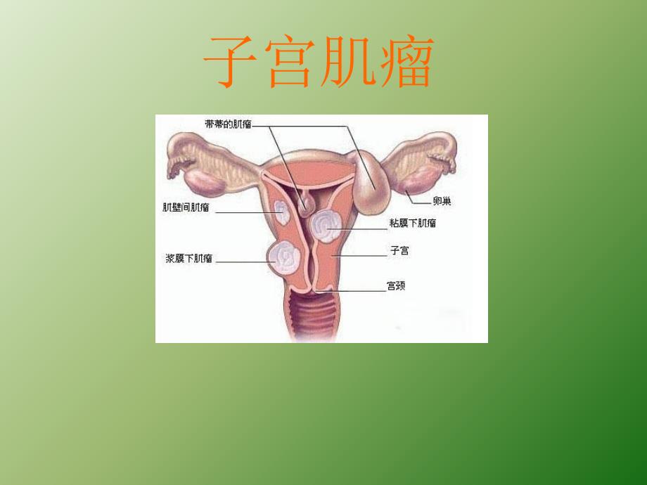 子宫肌瘤课件课件PPT演示ppt课件_第1页