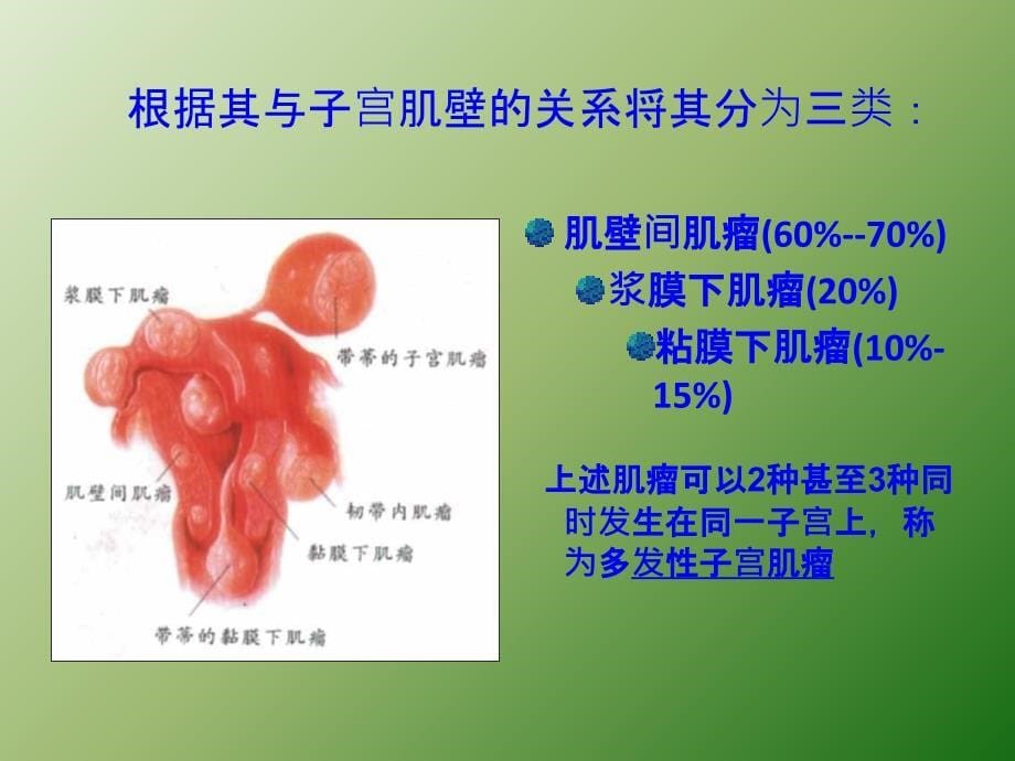 子宫肌瘤课件课件PPT演示ppt课件_第5页