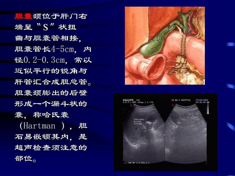 胆囊癌超声表现_第5页