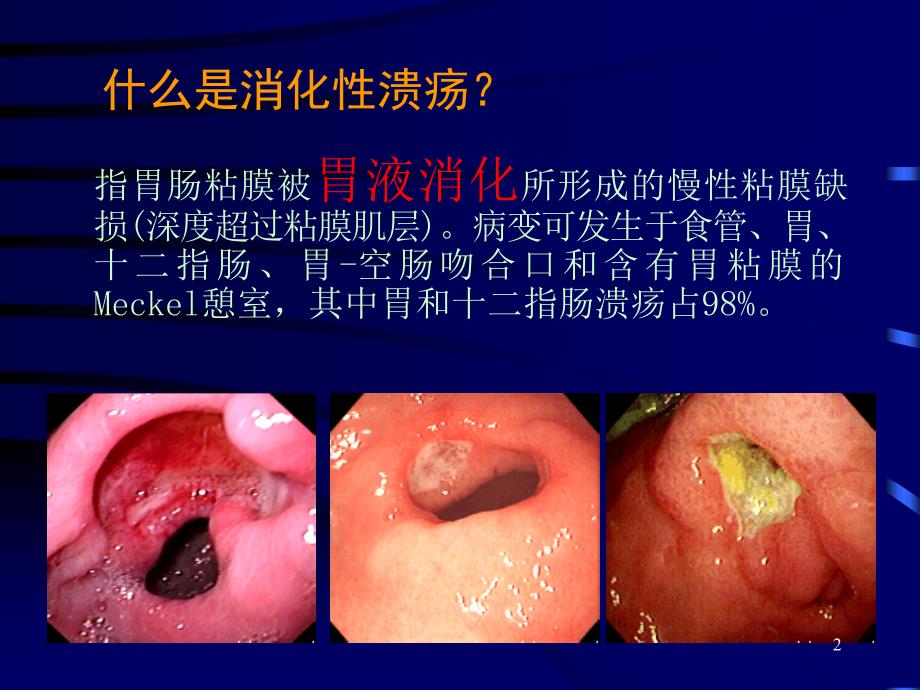 消化性溃疡PPT精品文档_第2页