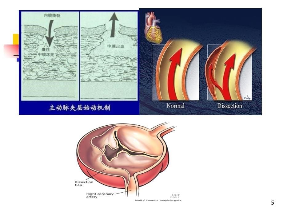 主动脉夹层的早期诊断与治疗ppt课件_第5页