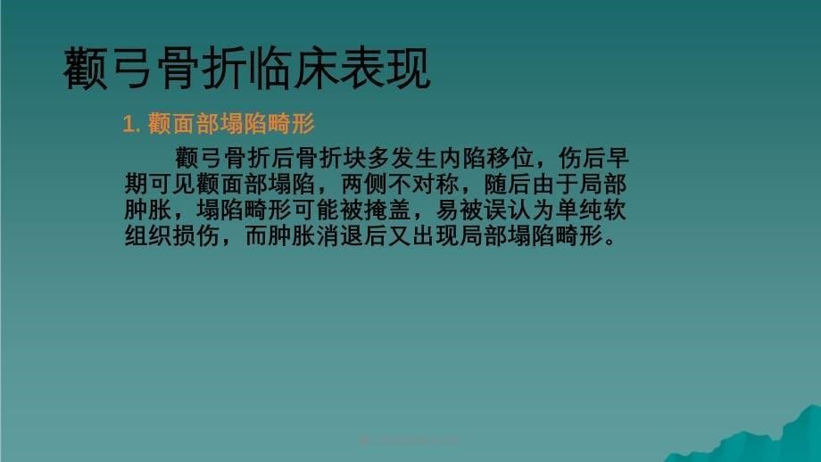 颧弓骨折的诊断与治疗课件_第5页