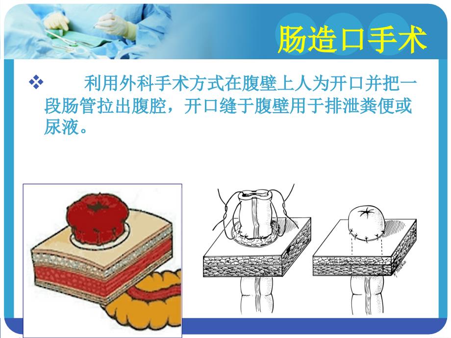 造口术前定位课件_第3页