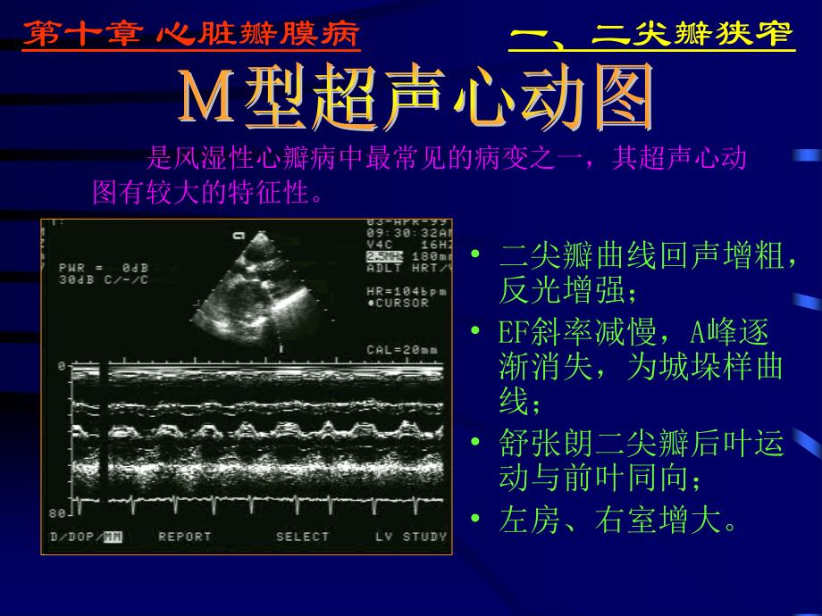 异常超声心动图通用课件_第3页