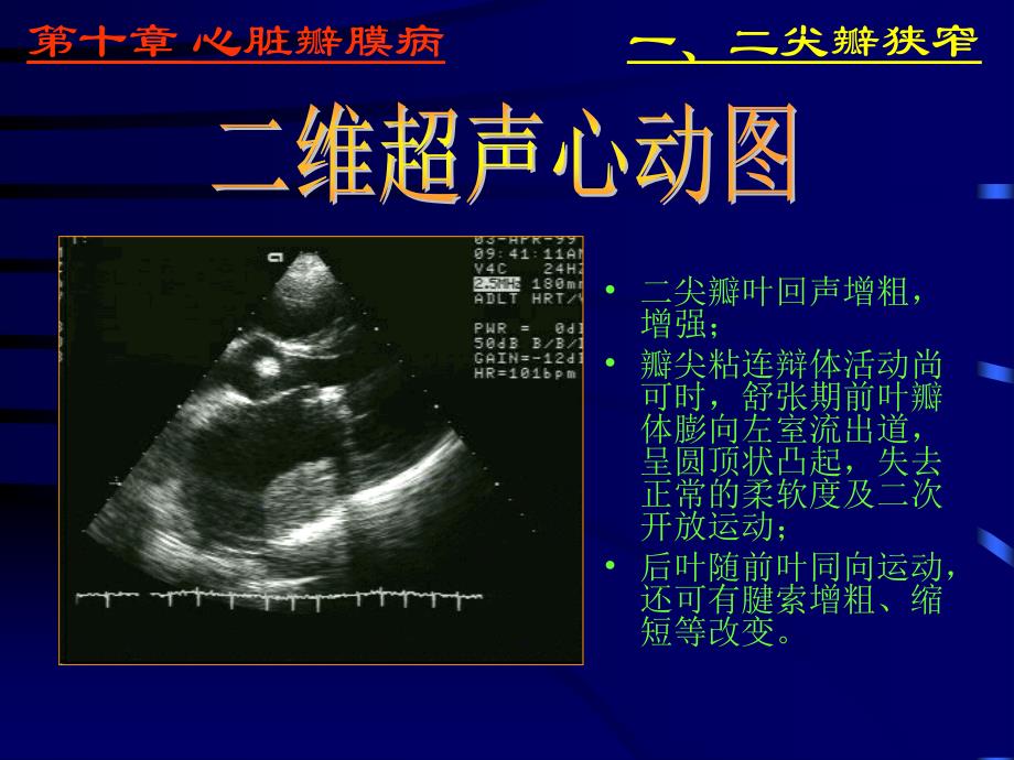 异常超声心动图通用课件_第4页