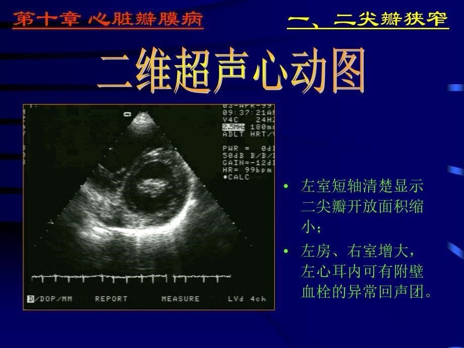 异常超声心动图通用课件_第5页