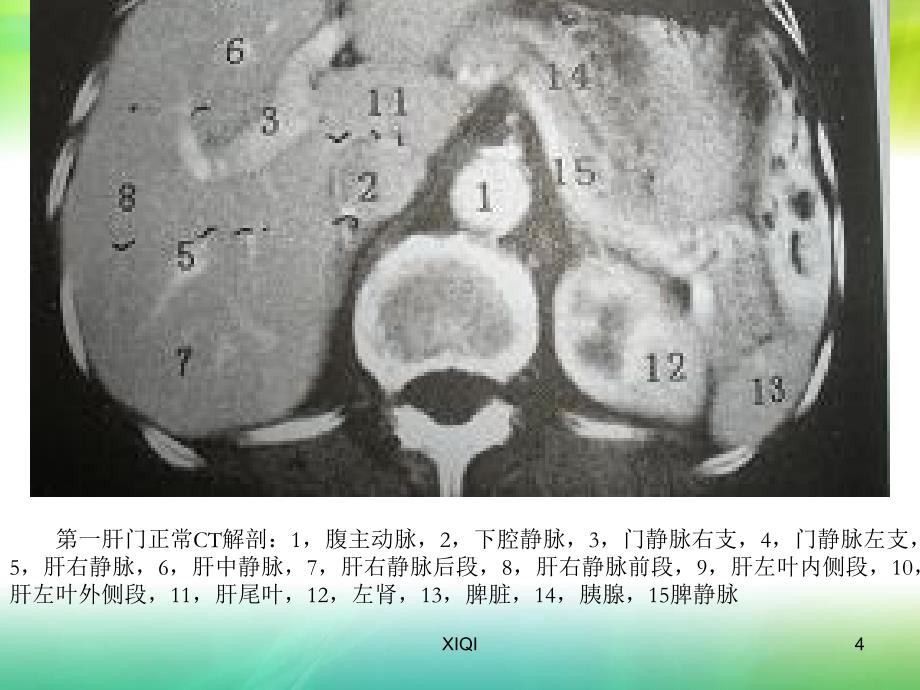 肝脏疾病影像学特点_第4页