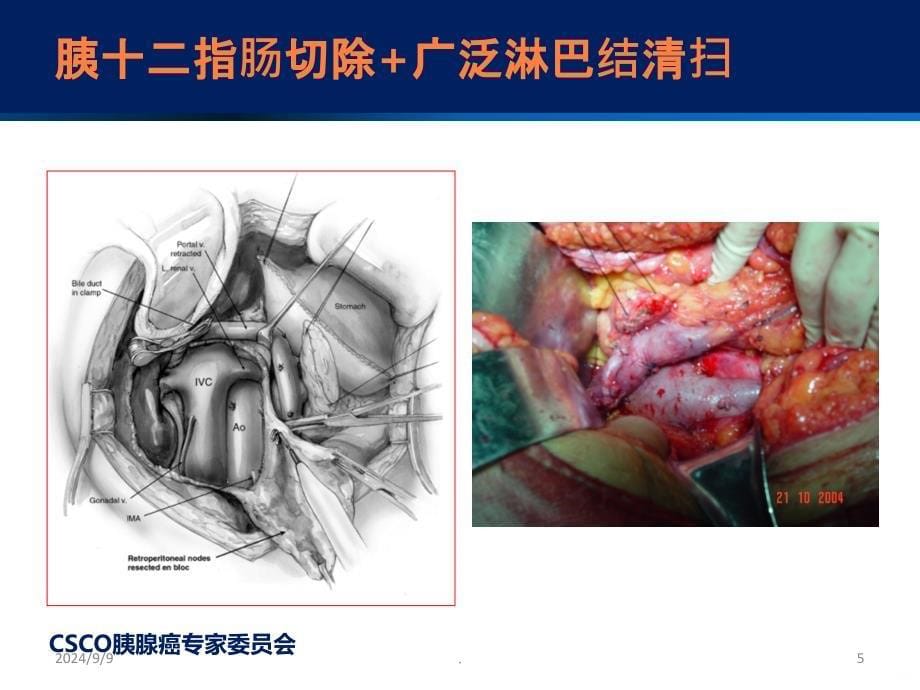 胰腺癌共识-外科+辅助化疗-课件_第5页