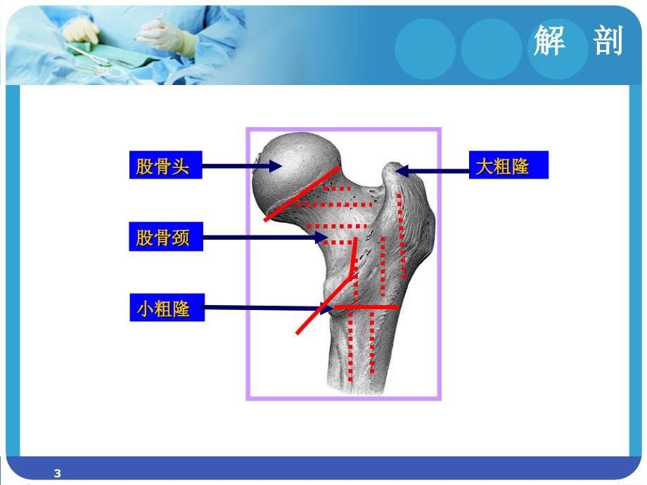 股骨颈骨折护理常规PPT参考课件_第3页