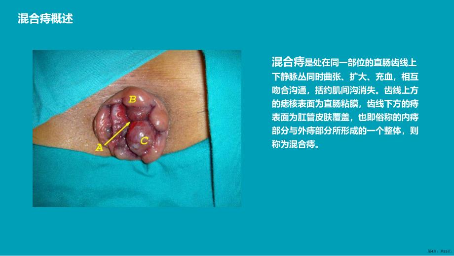 混合痔护理查房ppt课件PPT26页_第4页