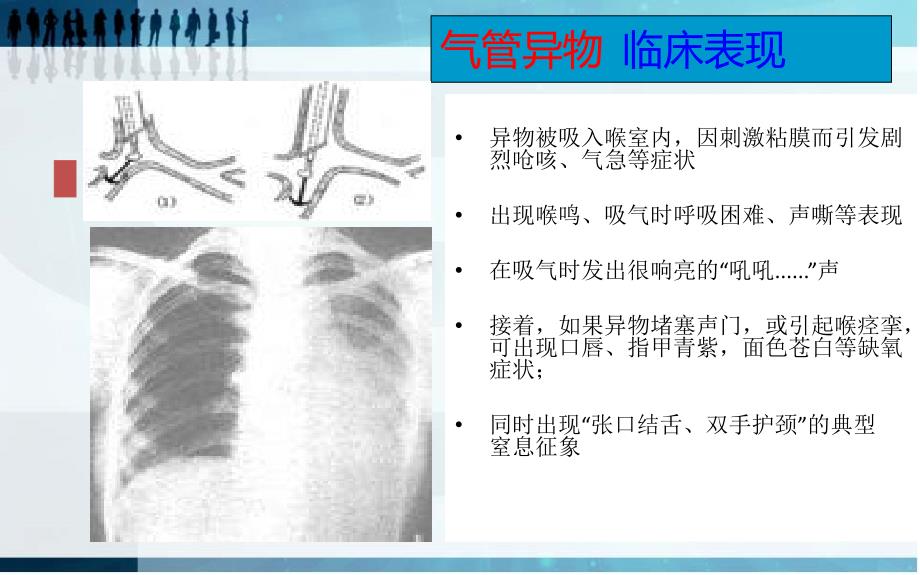 异物吸入课件课件_第4页