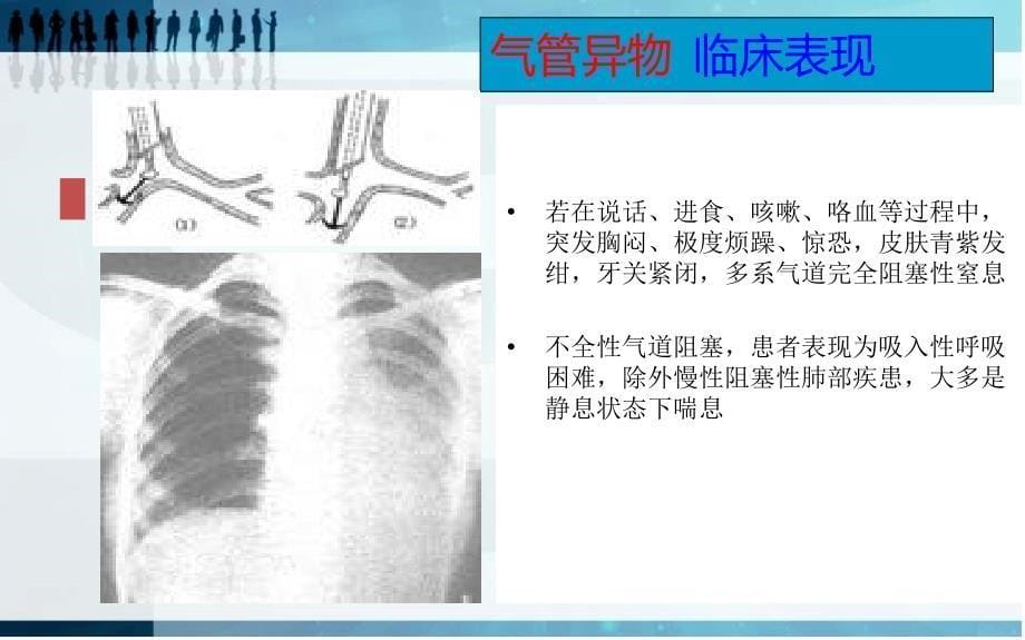 异物吸入课件课件_第5页