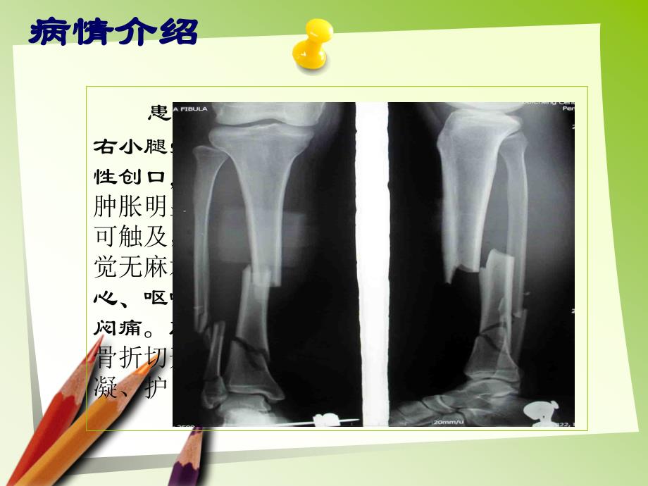 胫腓骨骨折的护理 ppt课件_第2页