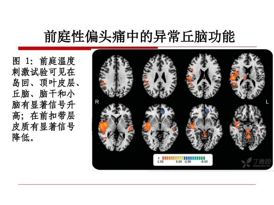 前庭性偏头痛诊断和鉴别_第5页