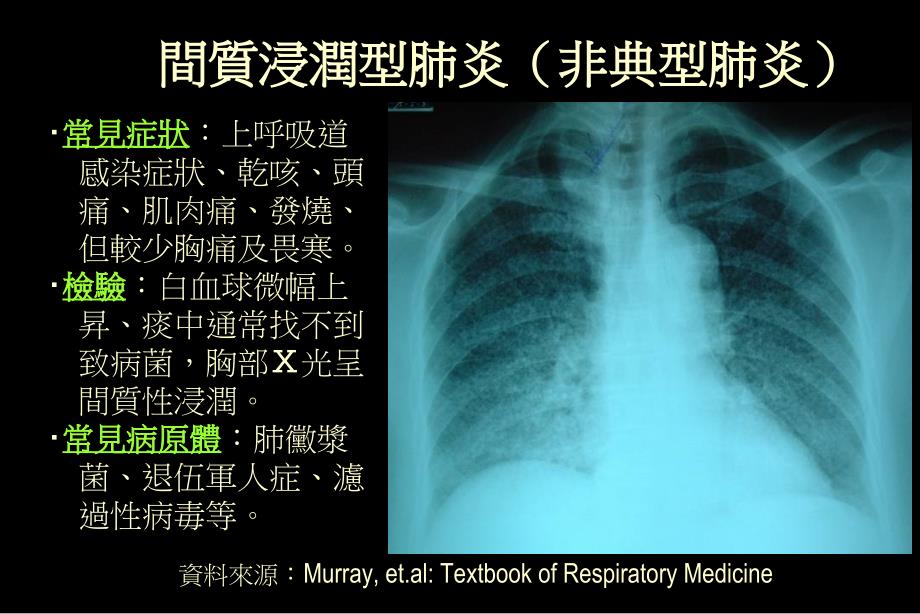 间质浸润型肺炎非典型肺炎_第1页