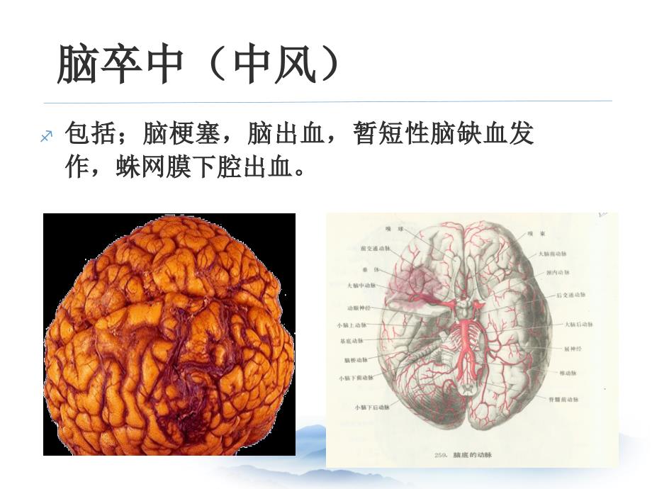 脑卒中的预防课件_第2页